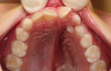 چرا دندان ها کج می شوند