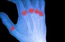 بیماری آرتریت روماتوئید را بشناسیم