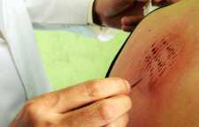 هر آنچه در مورد حجامت باید بدانید