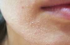 علت پوسته و لایه شدن پوست و روش های درمان آن