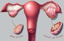 علت تنبلی تخمدان و راه های درمان آن