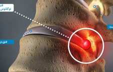 دیسک کمر و درمان آن