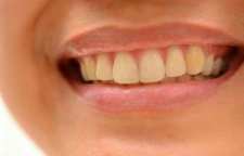 دلایل زرد شدن دندان ها