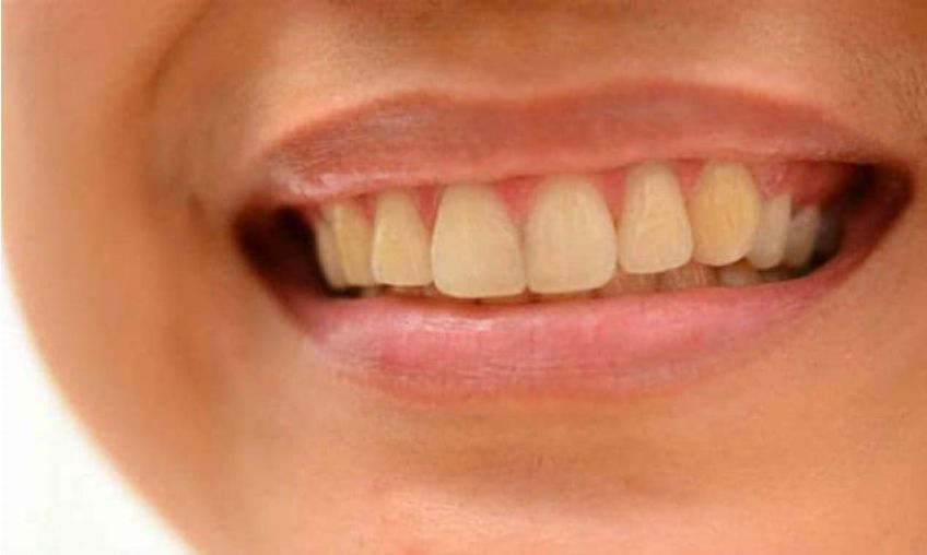 دلایل زرد شدن دندان ها