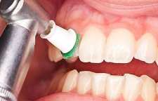 کاربرد بروساژ یا پولیشینگ دندان چیست