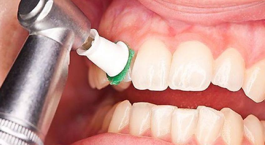 کاربرد بروساژ یا پولیشینگ دندان چیست