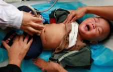 عوامل ایجاد سنگ کلیه در کودکان