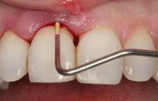 جرم گیری دندان را چند وقت یک بار انجام دهیم و روش خانگی از بین بردن آن