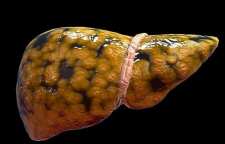 کبد چرب از چه راه هایی درمان می شوند