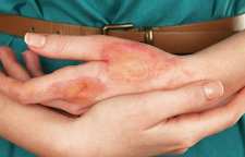 انواع سوختگی و درمان آن