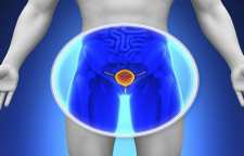 تشخیص سرطان پروستات و علائم آن