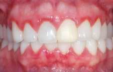 برای لثه ملتهب چه راه درمانی وجود دارد