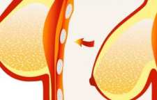 برفک نوک سینه چیست و روش های درمانی آن