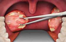 عفونت لوزه چه علائمی دارد و نحوه درمان آن چیست