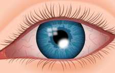 علل به وجود آمدن خشکی چشم و زخم قرنیه چیست؟