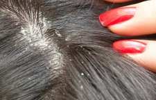 روش درست کردن 5 شامپو خانگی برای درمان شوره سر