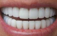 برای جرم گیری دندان در خانه چه روش هایی وجود دارد