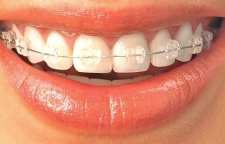 برای ارتودنسی چه سنی باید به دندانپزشکی مراجعه نماییم