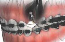 مشکلات دهانی و دندانی که ارتودنسی ممکن است ایجاد کند چیست