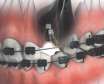 مشکلات دهانی و دندانی که ارتودنسی ممکن است ایجاد کند چیست
