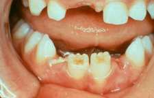 دیسپلازی دندانی و علائم آن