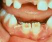 دیسپلازی دندانی و علائم آن