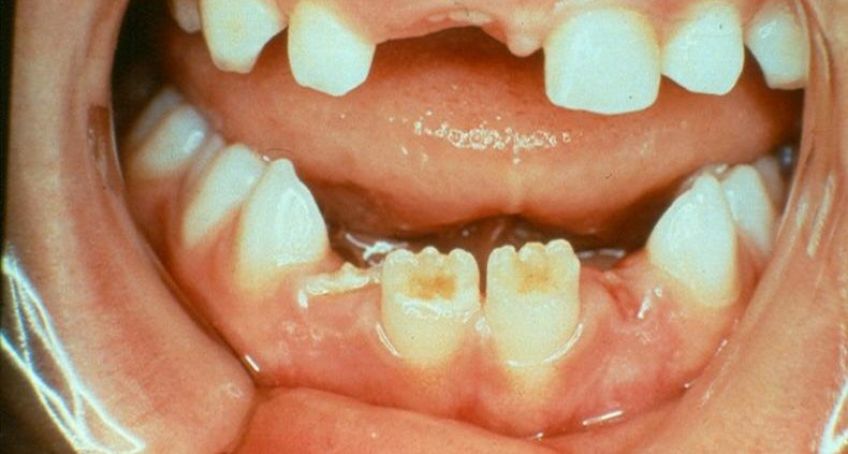 دیسپلازی دندانی و علائم آن