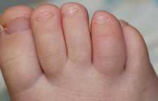 دلایلی که موجب می شود انگشتان دست و پا متورم شوند