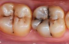 برای پیشگیری از پوسیدگی دندان چی بخوریم