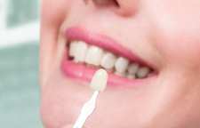 لمینت دندان چیست و مناسب چه افرادی است