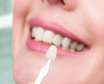 لمینت دندان چیست و مناسب چه افرادی است