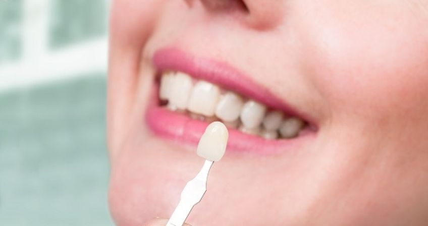 لمینت دندان چیست و مناسب چه افرادی است