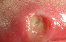 دلایل گاز گرفتگی گونه و زبان و درمان آن