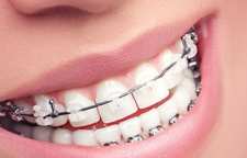 شرایط سنی برای انجام دادن ارتودنسی