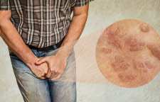 علت به وجود آمدن زگیل تناسلی و درمان خانگی آن