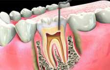 بررسی کانال ریشه و یا عصب کشی دندان