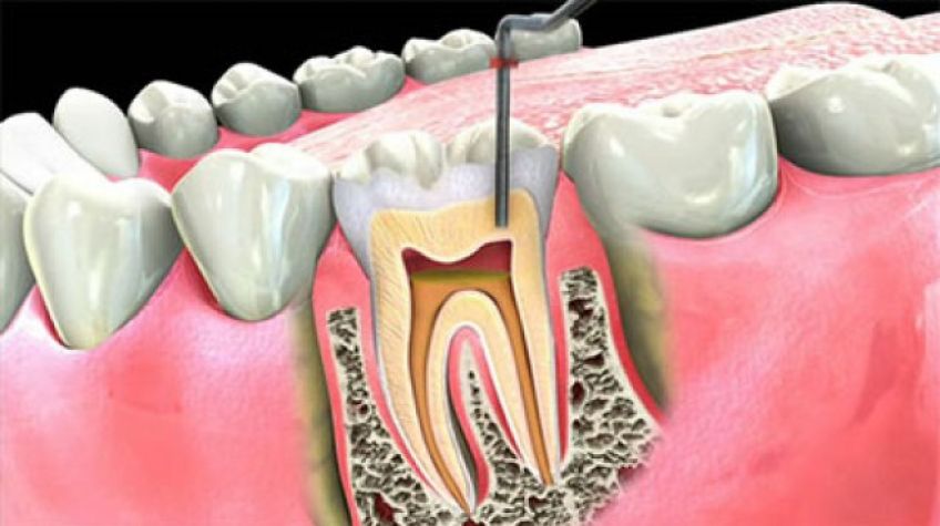 بررسی کانال ریشه و یا عصب کشی دندان