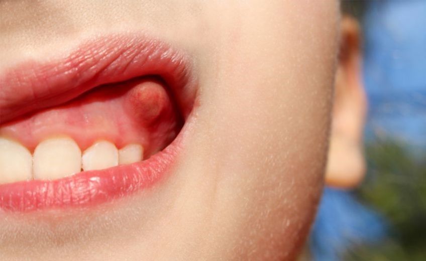 درمان عفونت دندان با ترکیبات خانگی
