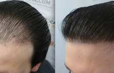 برای کاشت و پیوند مو چه سنی مناسب است