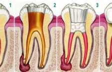 هر دندان چند کانال و ریشه دارد