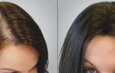 آیا زنان هم می توانند کاشت مو انجام دهند