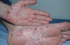 علائم بیماری جنسی و مقاربتی خطرناک کلامیدیا و روش های درمان آن