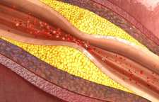 تاثیر کم خوابی بر ابتلا به مشکلات عروق خونی