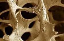 داروهای عامل پوکی استخوان