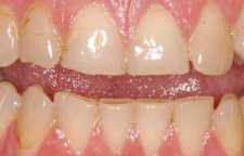 دلایل فرسودگی مینای دندان