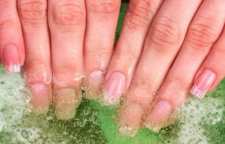 روش های برداشتن ناخن کاشته شده