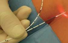 شقاق و یا فیشر مقعدی را به روش خانگی درمان کنیم