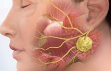 دلایل تورم ناحیه گلو و درمان آن