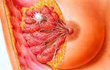 ماستیت و یا التهاب سینه مادران شیرده چگونه درمان می شود