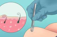 علت زیر پوستی شدن مو و روش درمان و جلوگیری از ایجاد آن